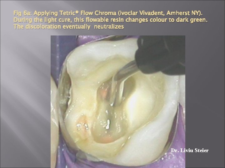 Fig 6 a: Applying Tetric® Flow Chroma (Ivoclar Vivadent, Amherst NY). During the light