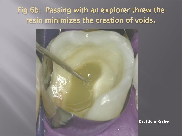 Fig 6 b: Passing with an explorer threw the resin minimizes the creation of