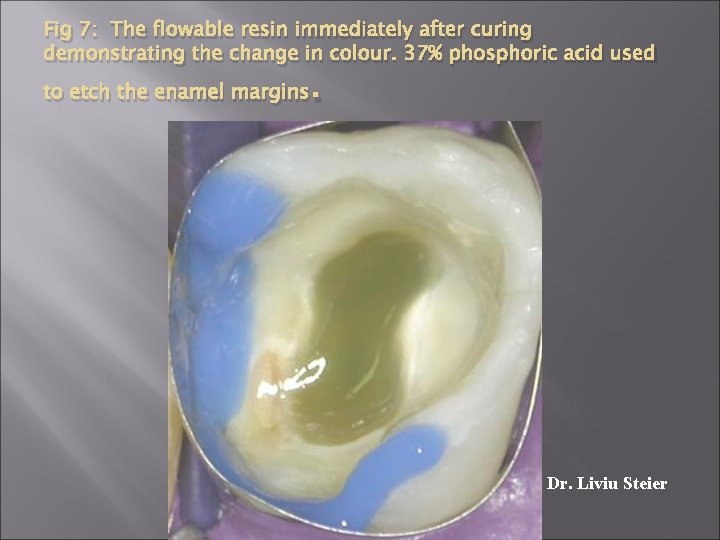 Fig 7: The flowable resin immediately after curing demonstrating the change in colour. 37%