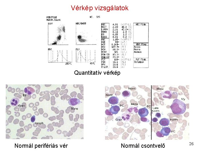 Vérkép vizsgálatok Quantitatív vérkép Normál perifériás vér Normál csontvelő 26 