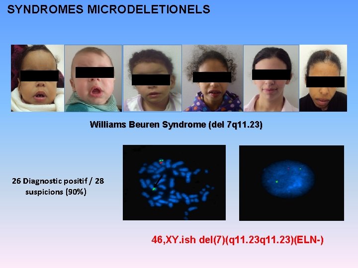 SYNDROMES MICRODELETIONELS Williams Beuren Syndrome (del 7 q 11. 23) 26 Diagnostic positif /