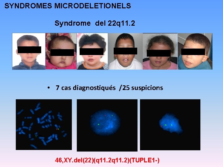 SYNDROMES MICRODELETIONELS Syndrome del 22 q 11. 2 • 7 cas diagnostiqués /25 suspicions