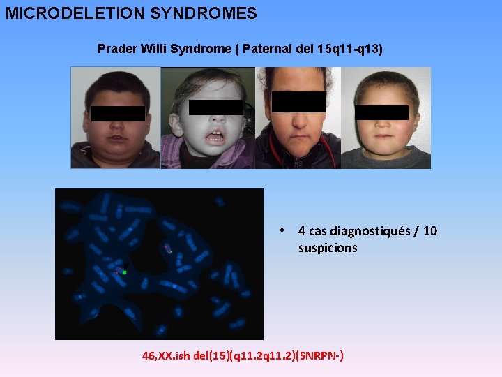 MICRODELETION SYNDROMES Prader Willi Syndrome ( Paternal del 15 q 11 -q 13) •