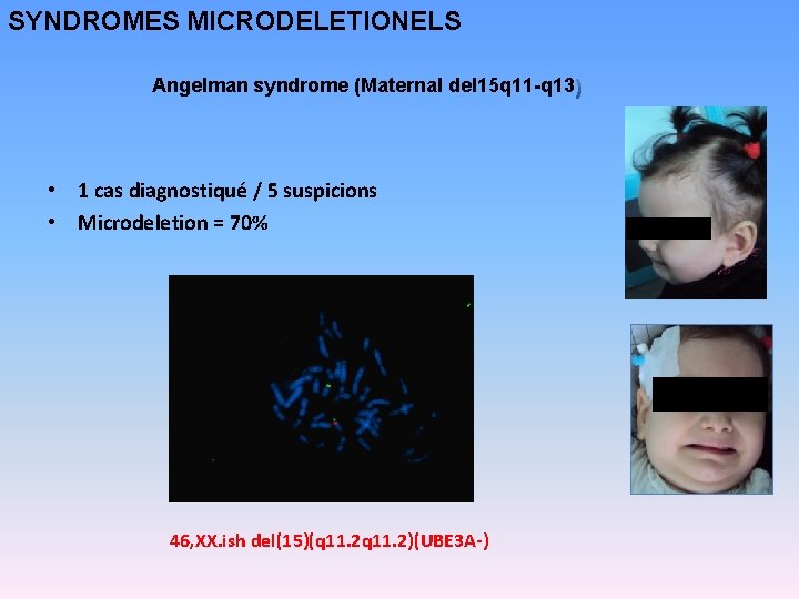 SYNDROMES MICRODELETIONELS Angelman syndrome (Maternal del 15 q 11 -q 13 • 1 cas