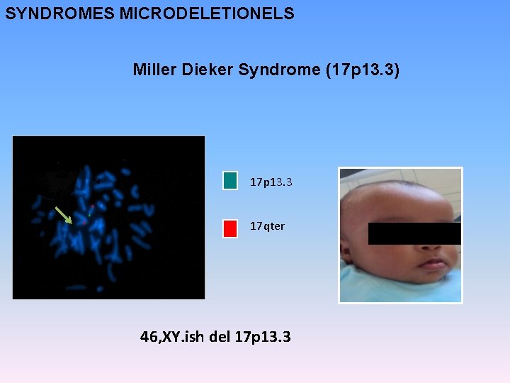 SYNDROMES MICRODELETIONELS Miller Dieker Syndrome (17 p 13. 3) 17 p 13. 3 17