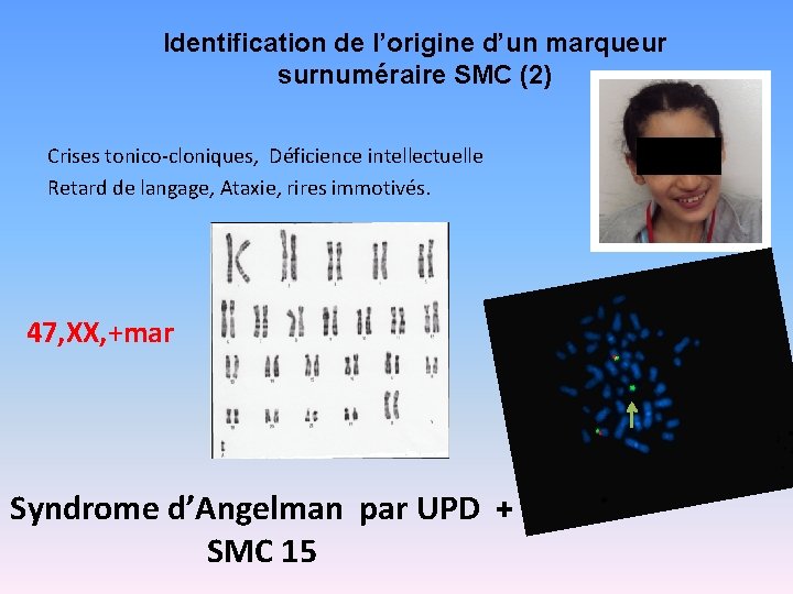 Identification de l’origine d’un marqueur surnuméraire SMC (2) Crises tonico-cloniques, Déficience intellectuelle Retard de