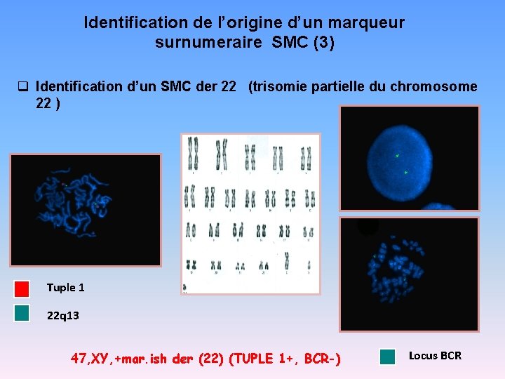 Identification de l’origine d’un marqueur surnumeraire SMC (3) q Identification d’un SMC der 22