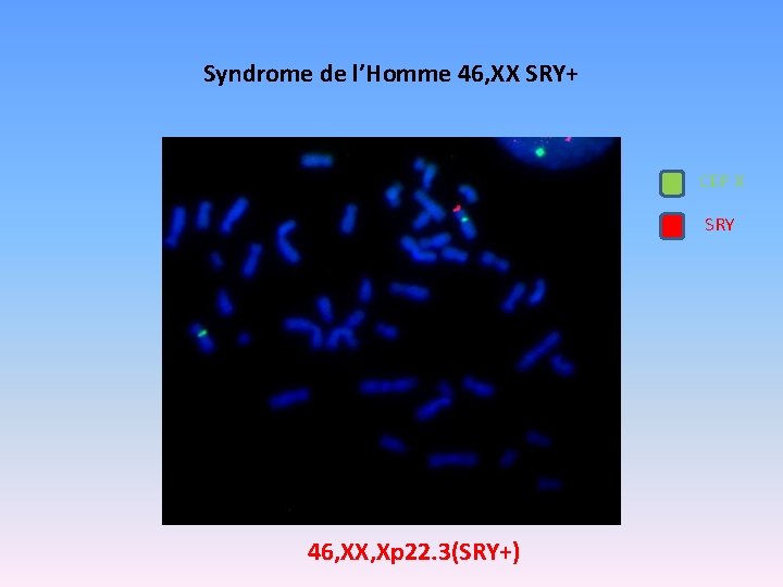 Syndrome de l’Homme 46, XX SRY+ CEP X SRY 46, XX, Xp 22. 3(SRY+)