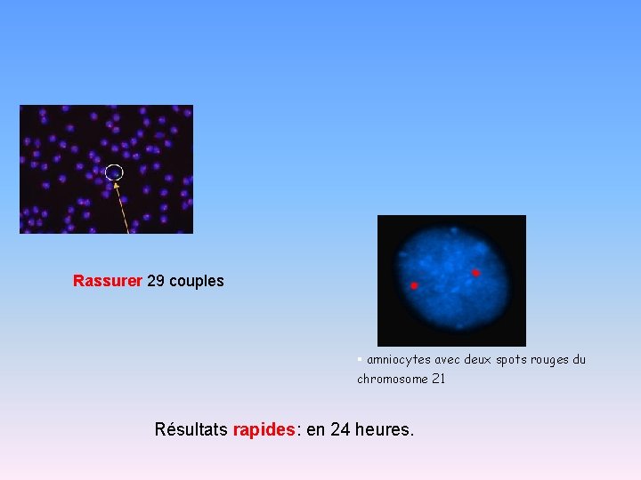 Rassurer 29 couples § amniocytes avec deux spots rouges du chromosome 21 Résultats rapides: