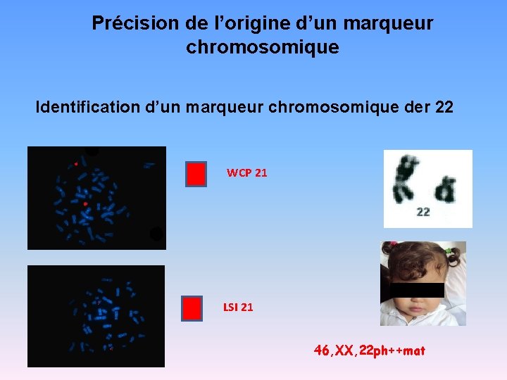 Précision de l’origine d’un marqueur chromosomique Identification d’un marqueur chromosomique der 22 WCP 21