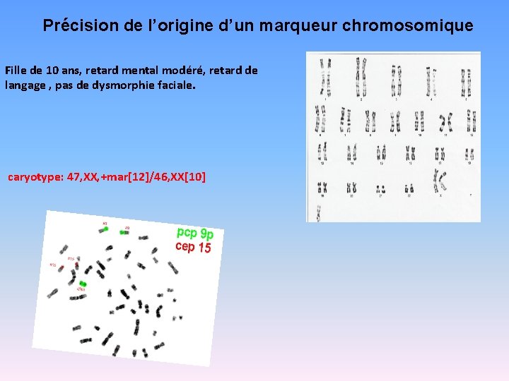 Précision de l’origine d’un marqueur chromosomique Fille de 10 ans, retard mental modéré, retard