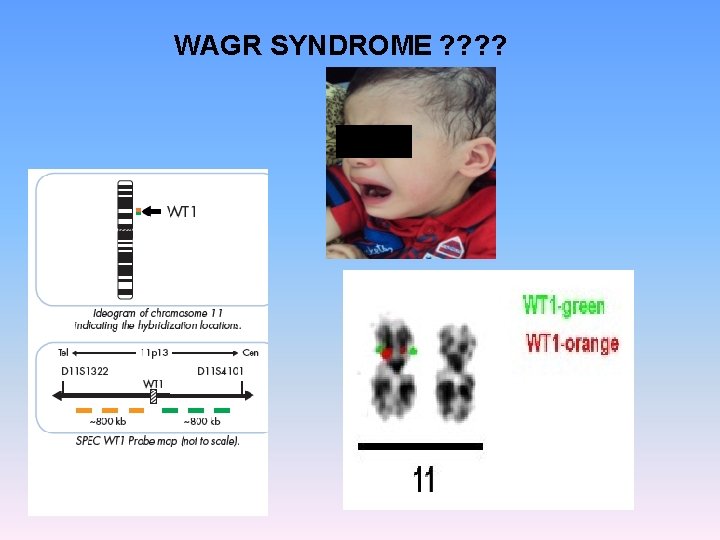WAGR SYNDROME ? ? 