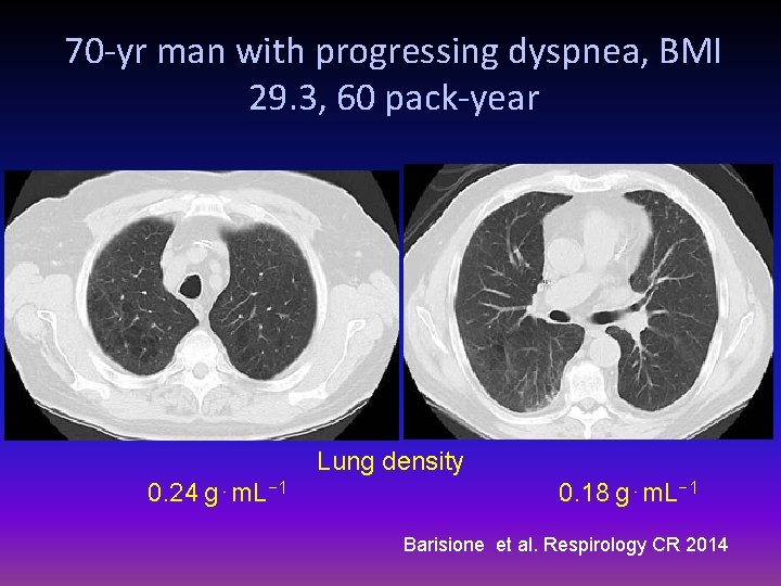 70 -yr man with progressing dyspnea, BMI 29. 3, 60 pack-year Lung density 0.