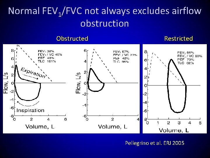 Normal FEV 1/FVC not always excludes airflow obstruction Obstructed Restricted Pellegrino et al. ERJ
