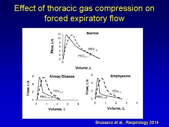 Effect of thoracic gas compression on forced expiratory flow Brusasco et al. , Respirology