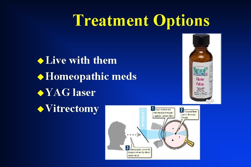 Treatment Options u Live with them u Homeopathic meds u YAG laser u Vitrectomy Treatment Options u Live with them u Homeopathic meds u YAG laser u Vitrectomy