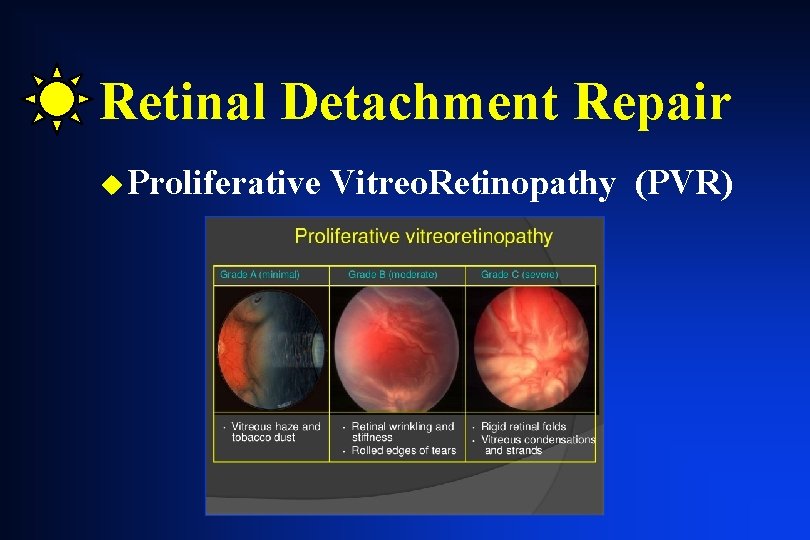 Retinal Detachment Repair u Proliferative Vitreo. Retinopathy (PVR) Retinal Detachment Repair u Proliferative Vitreo. Retinopathy (PVR)