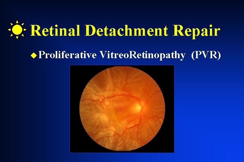 Retinal Detachment Repair u Proliferative Vitreo. Retinopathy (PVR) Retinal Detachment Repair u Proliferative Vitreo. Retinopathy (PVR)
