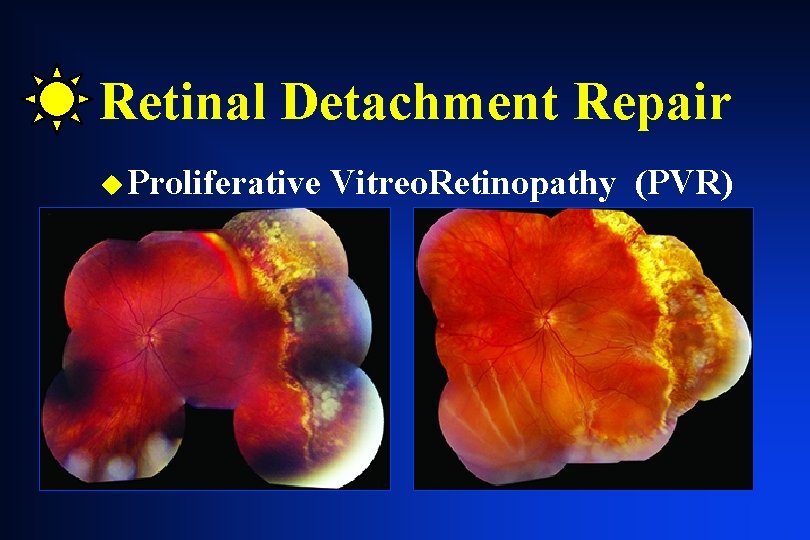 Retinal Detachment Repair u Proliferative Vitreo. Retinopathy (PVR) Retinal Detachment Repair u Proliferative Vitreo. Retinopathy (PVR)