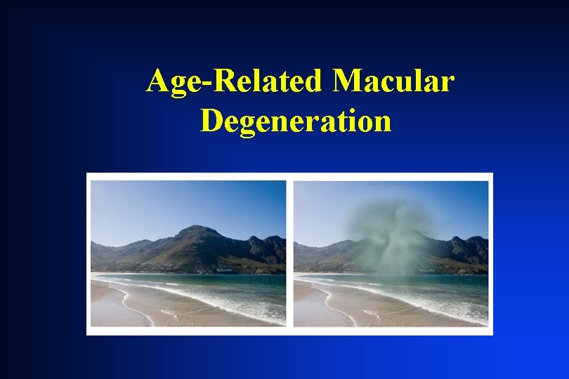 Age-Related Macular Degeneration Age-Related Macular Degeneration