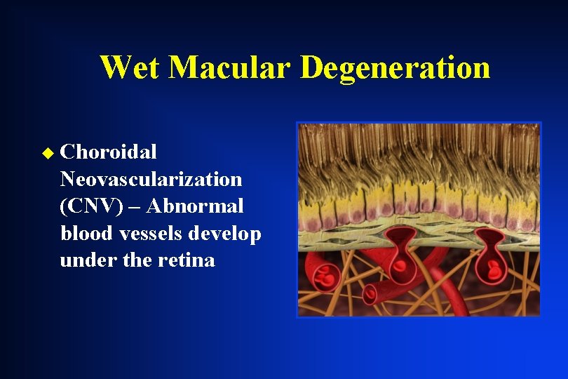 Wet Macular Degeneration u Choroidal Neovascularization (CNV) – Abnormal blood vessels develop under the Wet Macular Degeneration u Choroidal Neovascularization (CNV) – Abnormal blood vessels develop under the