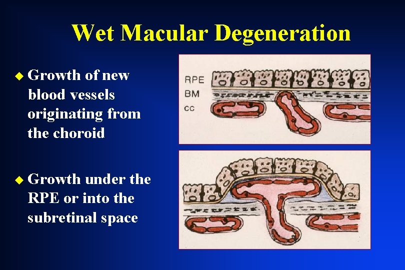 Wet Macular Degeneration u Growth of new blood vessels originating from the choroid u Wet Macular Degeneration u Growth of new blood vessels originating from the choroid u
