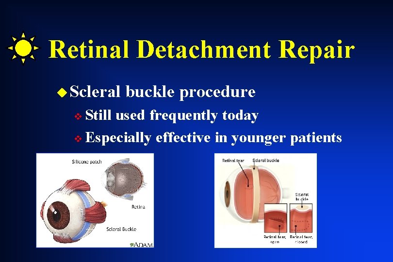 Retinal Detachment Repair u Scleral buckle procedure Still used frequently today v Especially effective Retinal Detachment Repair u Scleral buckle procedure Still used frequently today v Especially effective