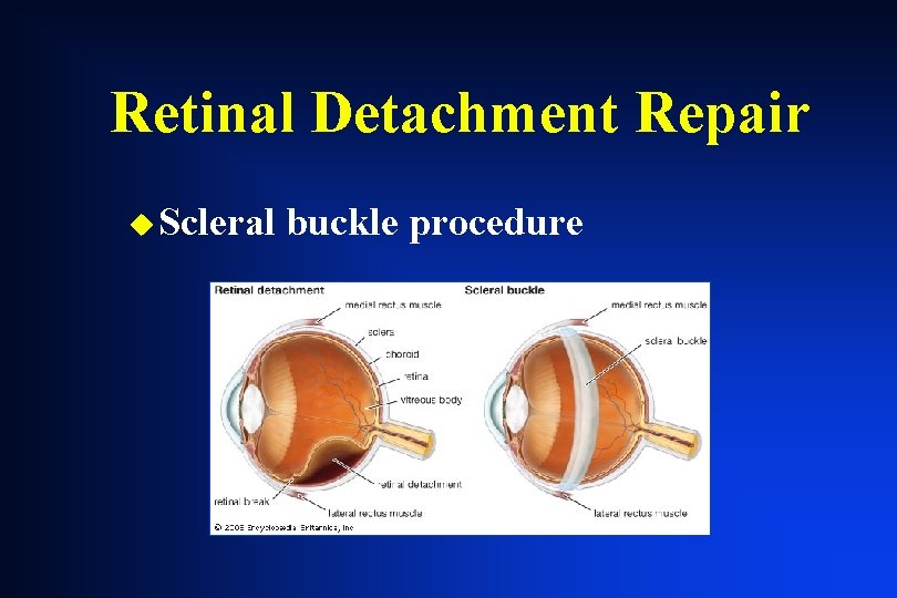 Retinal Detachment Repair u Scleral buckle procedure Retinal Detachment Repair u Scleral buckle procedure