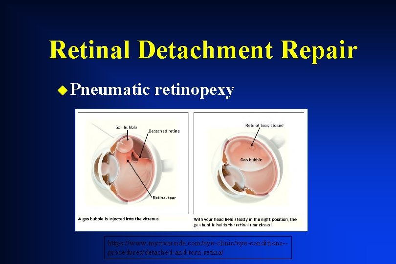 Retinal Detachment Repair u Pneumatic retinopexy https: //www. myriverside. com/eye-clinic/eye-conditions-procedures/detached-and-torn-retina/ Retinal Detachment Repair u Pneumatic retinopexy https: //www. myriverside. com/eye-clinic/eye-conditions-procedures/detached-and-torn-retina/