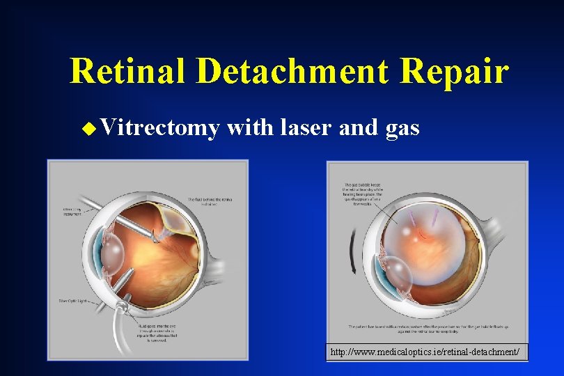 Retinal Detachment Repair u Vitrectomy with laser and gas http: //www. medicaloptics. ie/retinal-detachment/ Retinal Detachment Repair u Vitrectomy with laser and gas http: //www. medicaloptics. ie/retinal-detachment/