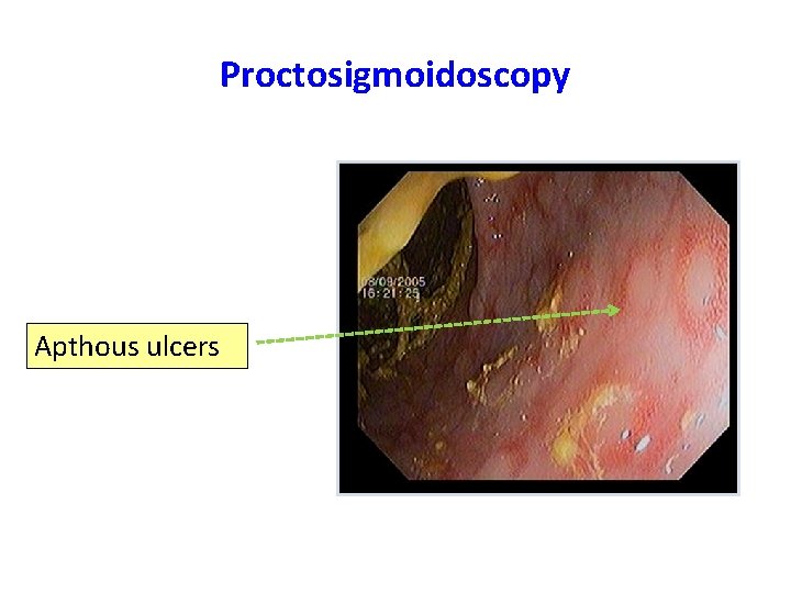 Proctosigmoidoscopy Apthous ulcers 