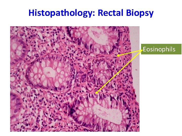 Histopathology: Rectal Biopsy Eosinophils 