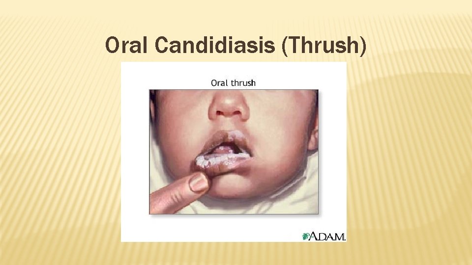 Oral Candidiasis (Thrush) 