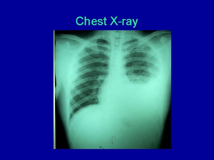 Chest X-ray Chest X-ray