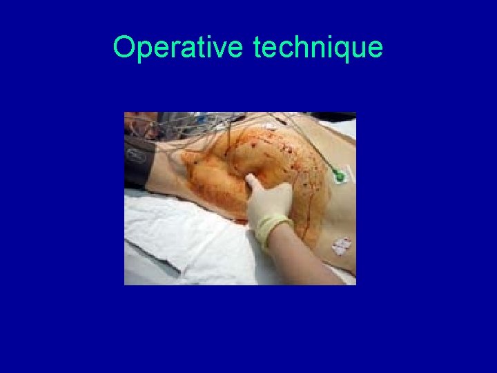 Operative technique Operative technique