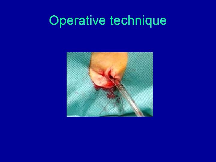 Operative technique Operative technique