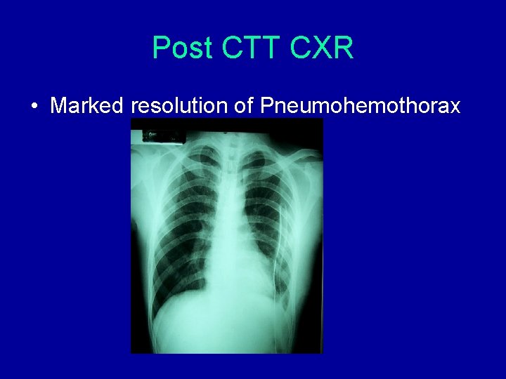 Post CTT CXR • Marked resolution of Pneumohemothorax Post CTT CXR • Marked resolution of Pneumohemothorax