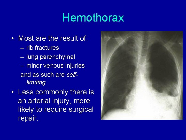 Hemothorax • Most are the result of: – rib fractures – lung parenchymal – Hemothorax • Most are the result of: – rib fractures – lung parenchymal –