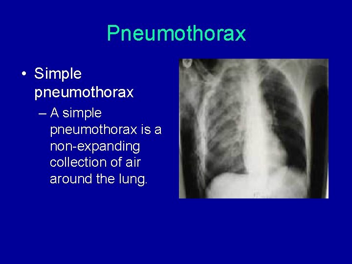 Pneumothorax • Simple pneumothorax – A simple pneumothorax is a non-expanding collection of air Pneumothorax • Simple pneumothorax – A simple pneumothorax is a non-expanding collection of air