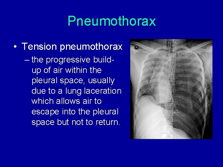 Pneumothorax • Tension pneumothorax – the progressive buildup of air within the pleural space, Pneumothorax • Tension pneumothorax – the progressive buildup of air within the pleural space,