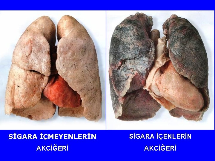 SİGARA İÇMEYENLERİN SİGARA İÇENLERİN AKCİĞERİ 