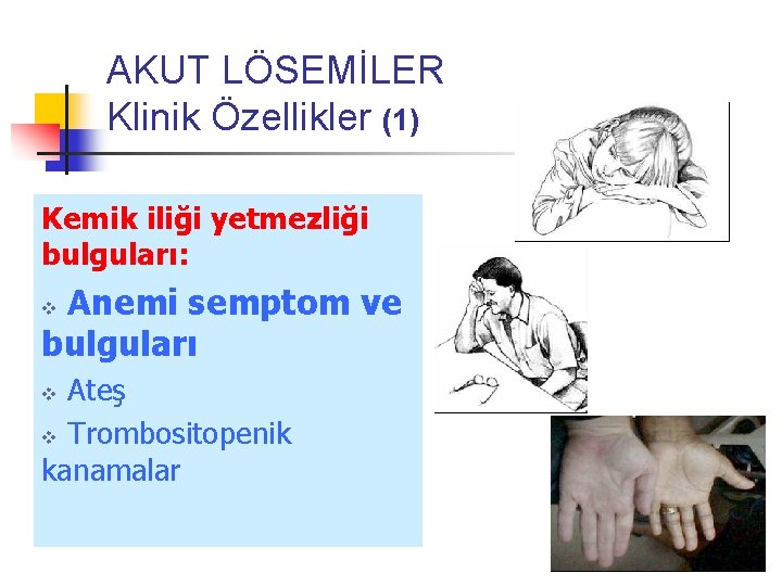 AKUT LÖSEMİLER Klinik Özellikler (1) Kemik iliği yetmezliği bulguları: Anemi semptom ve bulguları v