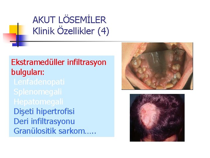 AKUT LÖSEMİLER Klinik Özellikler (4) Ekstramedüller infiltrasyon bulguları: Lenfadenopati Splenomegali Hepatomegali Dişeti hipertrofisi Deri