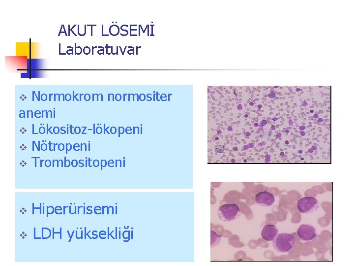 AKUT LÖSEMİ Laboratuvar Normokrom normositer anemi v Lökositoz-lökopeni v Nötropeni v Trombositopeni v v