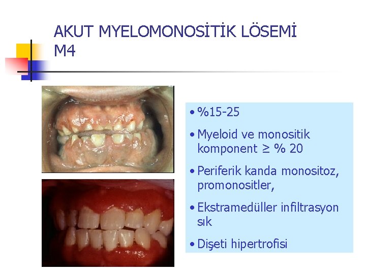 AKUT MYELOMONOSİTİK LÖSEMİ M 4 • %15 -25 • Myeloid ve monositik komponent ≥