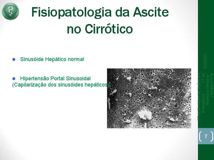 Sinusóide Hepático normal Hipertensão Portal Sinusoidal (Capilarização dos sinusóides hepáticos) CT de Medicina de