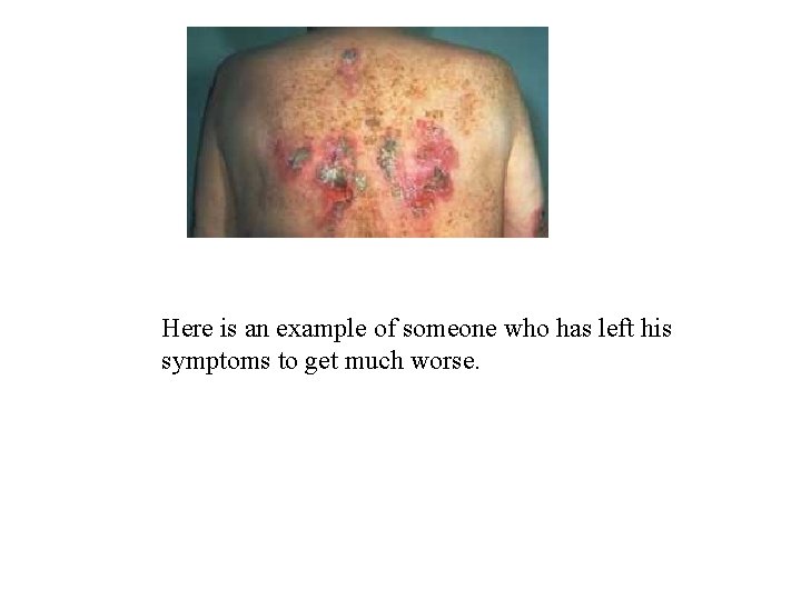 Here is an example of someone who has left his symptoms to get much