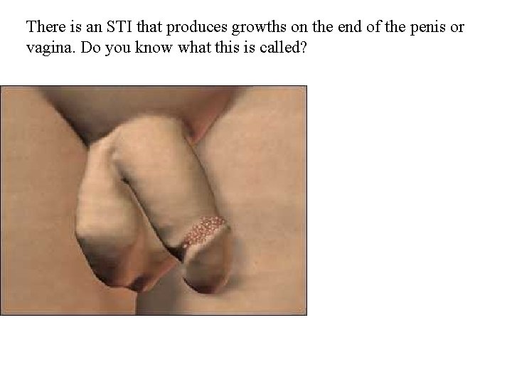 There is an STI that produces growths on the end of the penis or