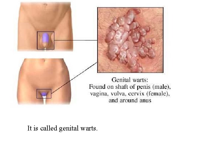 It is called genital warts. 