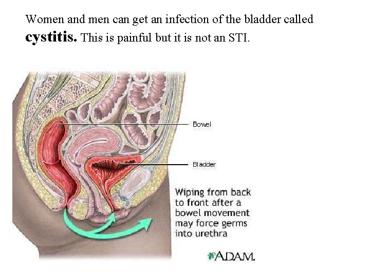 Women and men can get an infection of the bladder called cystitis. This is